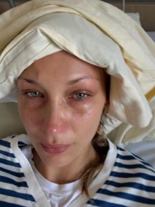 Bella Hadid souffre de la maladie de Lyme : qu’est-ce que cette infection « invisible » ?
