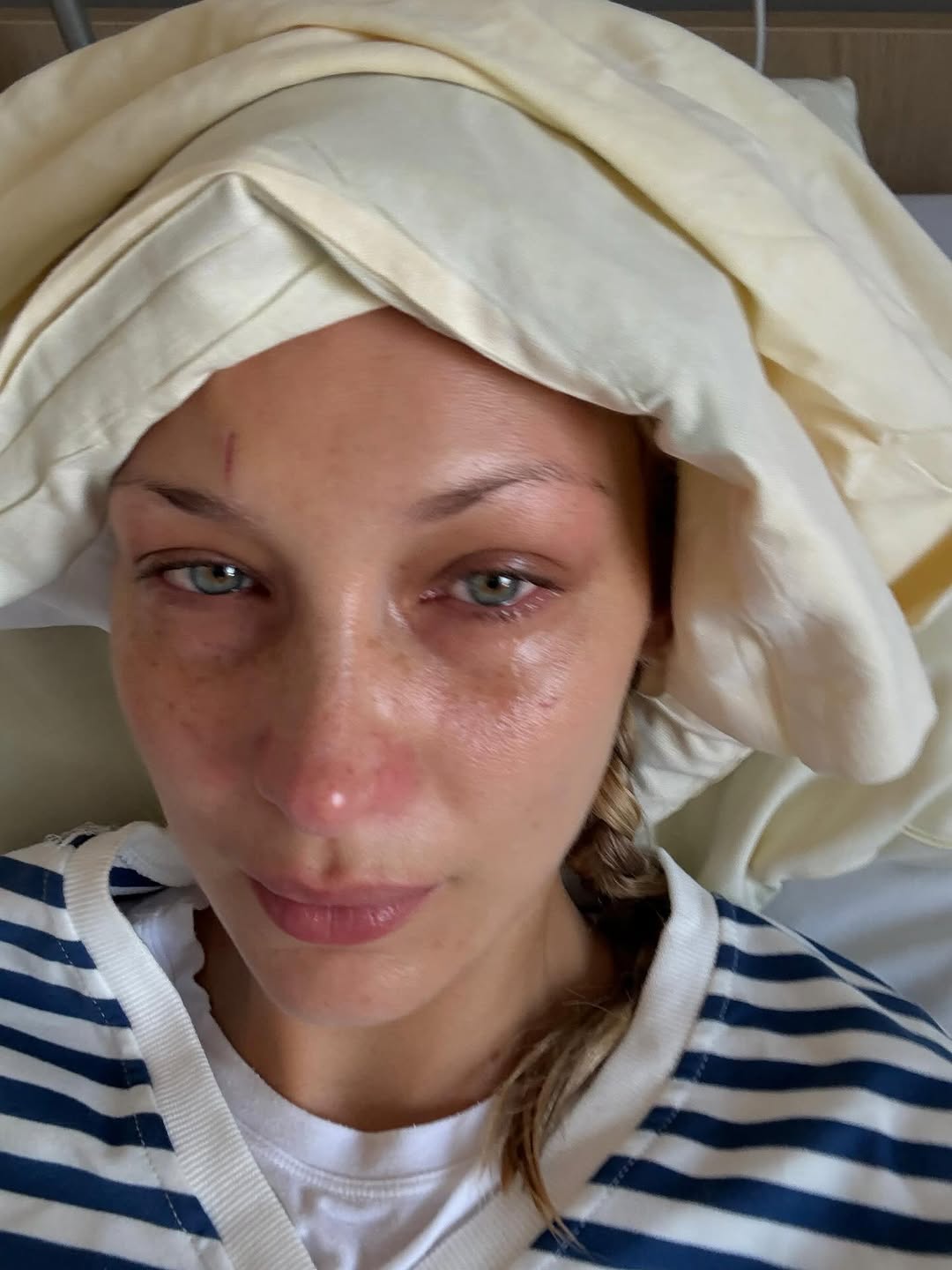 Bella Hadid souffre de la maladie de Lyme : qu’est-ce que cette infection « invisible » ?